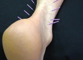 acupuncture