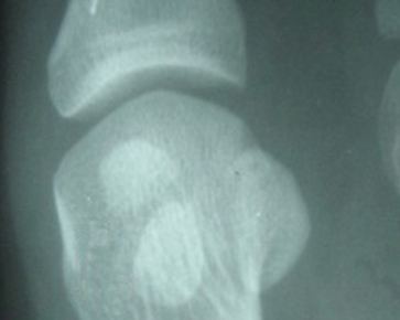 Sesamoiditis - Foot Pain Centres of Leeds