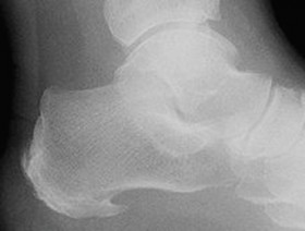 calcaneal-spur