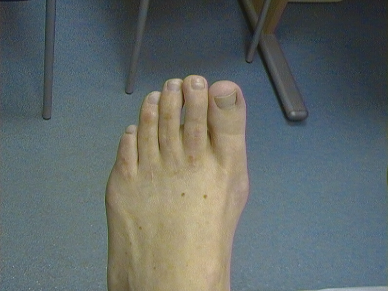 Hammer Toe Surgery Foot Pain Centres of Leeds