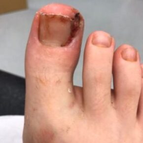 ingrowing toe nail