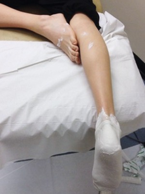 Negative plaster cast ensuring that hip, knee and ankle are all in correct alignment