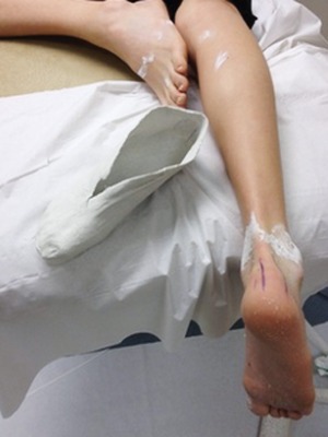 pre cast making for orthotics – image of leg with foot hanging over table