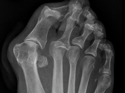 X-ray of foot fom top