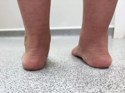 Example of flat feet in a child