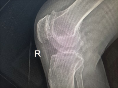 xray of arthritic knee
