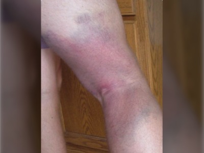 bruised Hamstring Injury Assessment and Treatment
