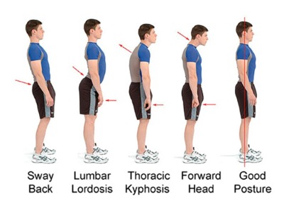 Postural imbalance treatment Leeds