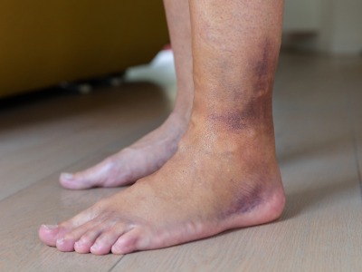 FPC common conditions Ankle Sprains