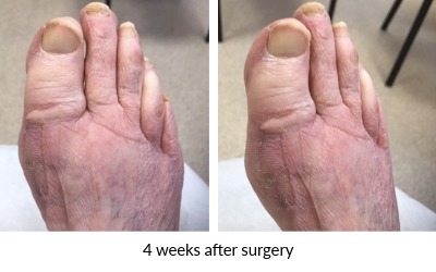 image of Hallux rigidus and bunion 4 weeks post-surgery