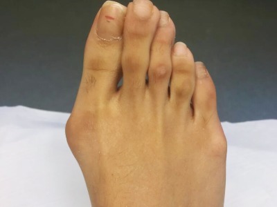 Bunion (Hallux Valgus) Assessment and Treatment in Leeds