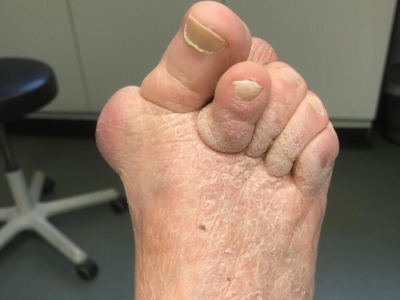 servere Bunion (Hallux Valgus) Assessment and Treatment in Leeds