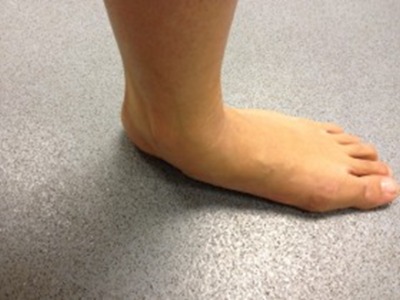 Flat Foot Assessment and Treatment in Leeds
