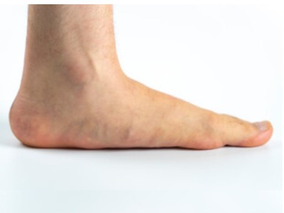 Flat Foot Assessment and Treatment in Leeds