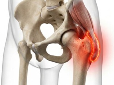 Iliotibial Band (ITB) and Trochanteric Pain Assessment