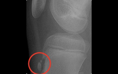 xray of Osgood Schlatter’s Disease in the knee