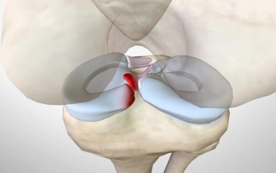 Meniscal or Cartilage Knee Pain. The menisci are C-shaped pieces of cartilage
