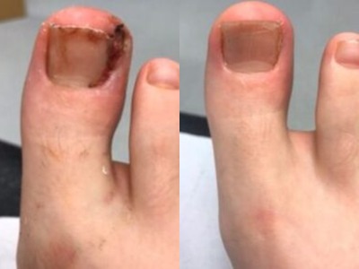 before and after Ingrown Toenail Treatment in Leeds