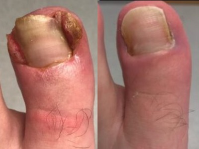 before and after Ingrown Toenail Treatment in Leeds