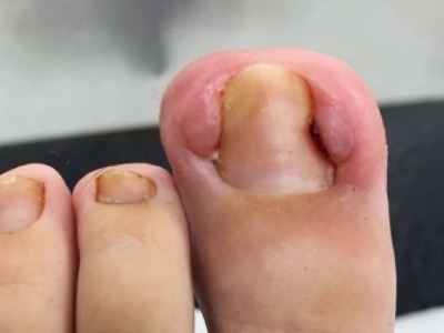 Ingrowing toenail photo